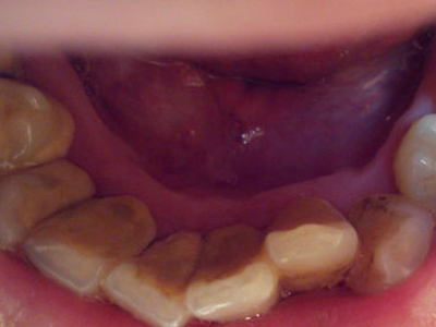 口腔溃疡口腔白斑可别分不清 其中有一个是癌前病变!