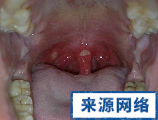 口腔潰瘍 小指頭 病變 廈門第一醫院 耳鼻喉科