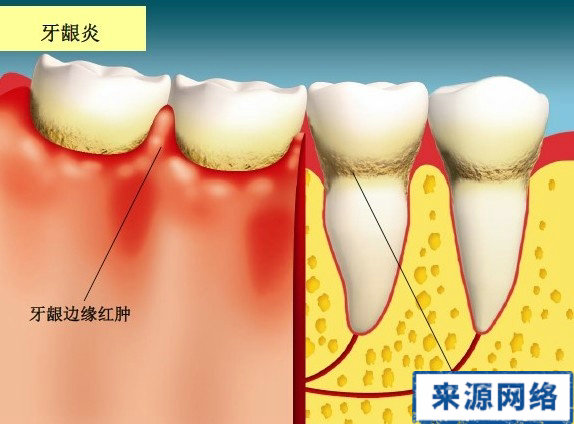 牙周炎症狀 牙周炎圖片 牙周炎症狀圖片